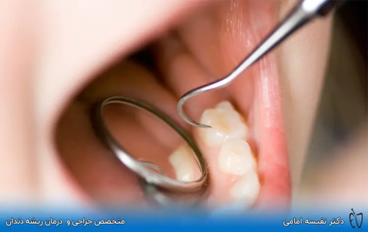 چند روز بعد از عصب کشی دندان را پر کنیم؟