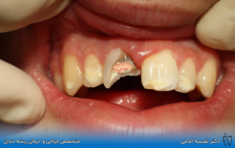 علت درد دندان شکسته شده