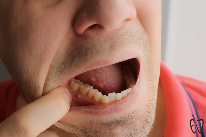 عفونت دندان بعد از ایمپلنت
