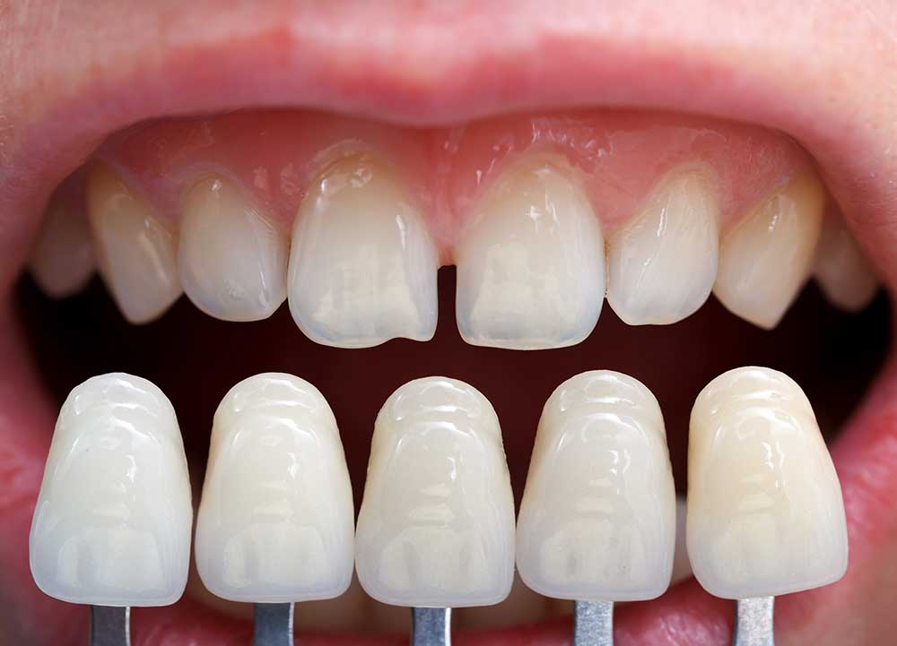 مراحل لمینت دندان ها