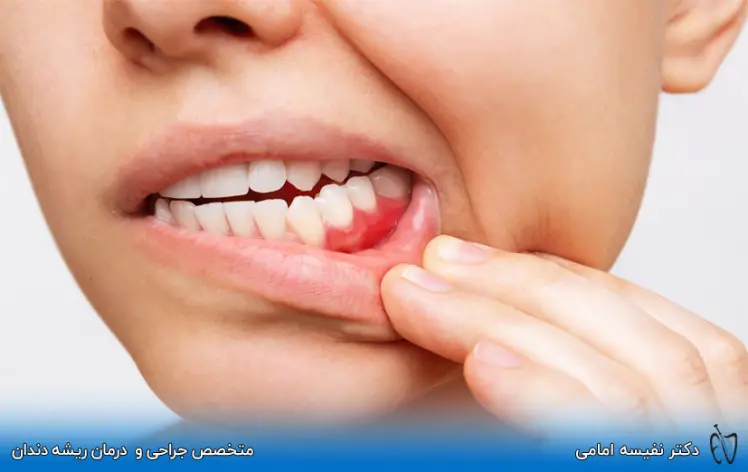 فرق کیست و آبسه دندانی چیست؟