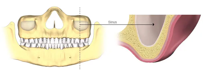 ریشه دندان در سینوس