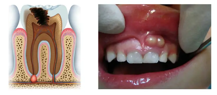 تفاوت آبسه و کیست دندان