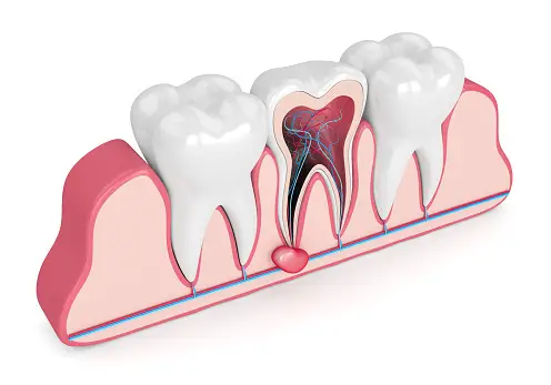 علائم کیست دندانی
