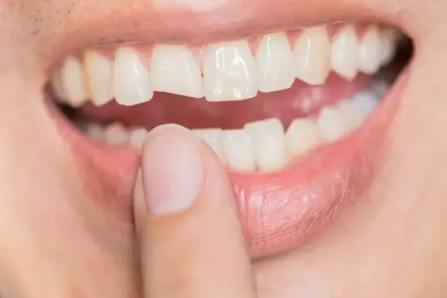 لب پریدگی دندان