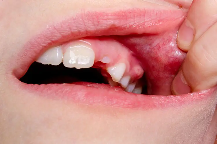 درمان آبسه دندان در خانه