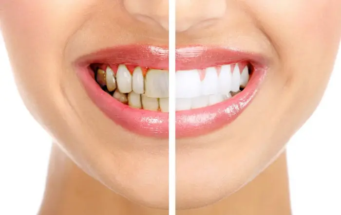 قبل و بعد جرم گیری دندان