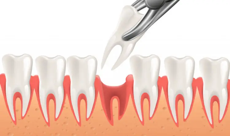 درد زیاد بعد کشیدن دندان